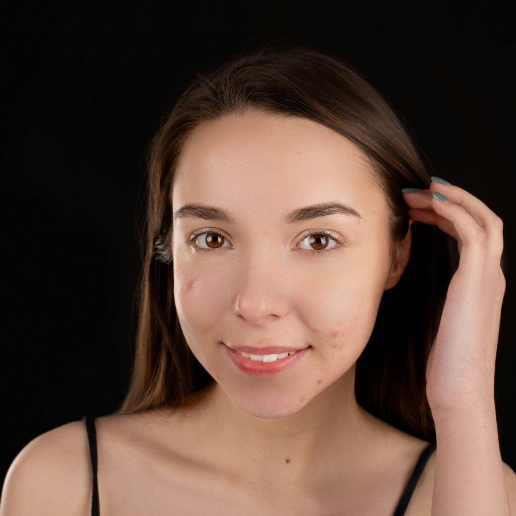 Acne-Prone Skin? Here’s How to Clear Your Breakouts for Good